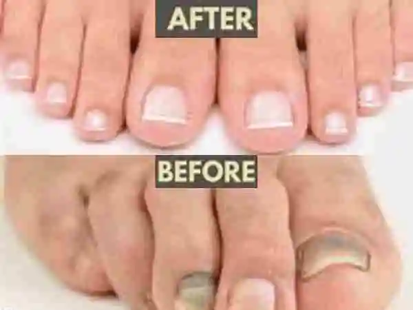 Can You Use Essential Oil for Toenail Fungus